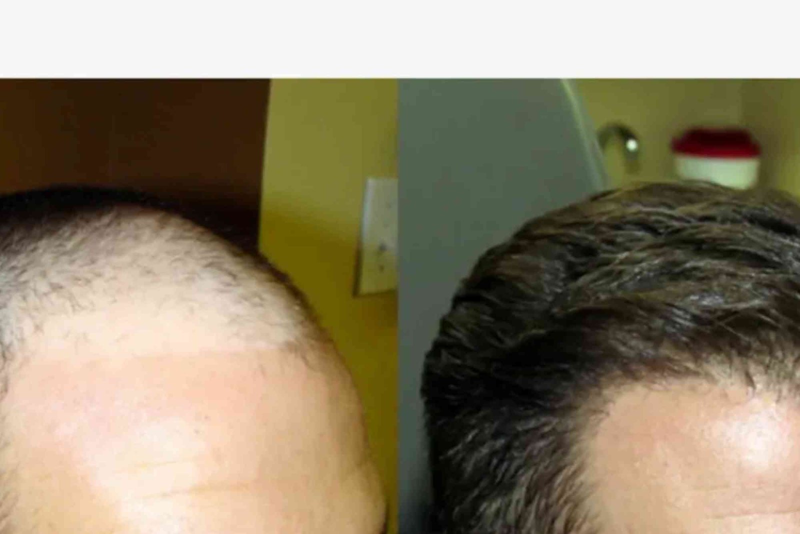 Hair Transplant Turkey